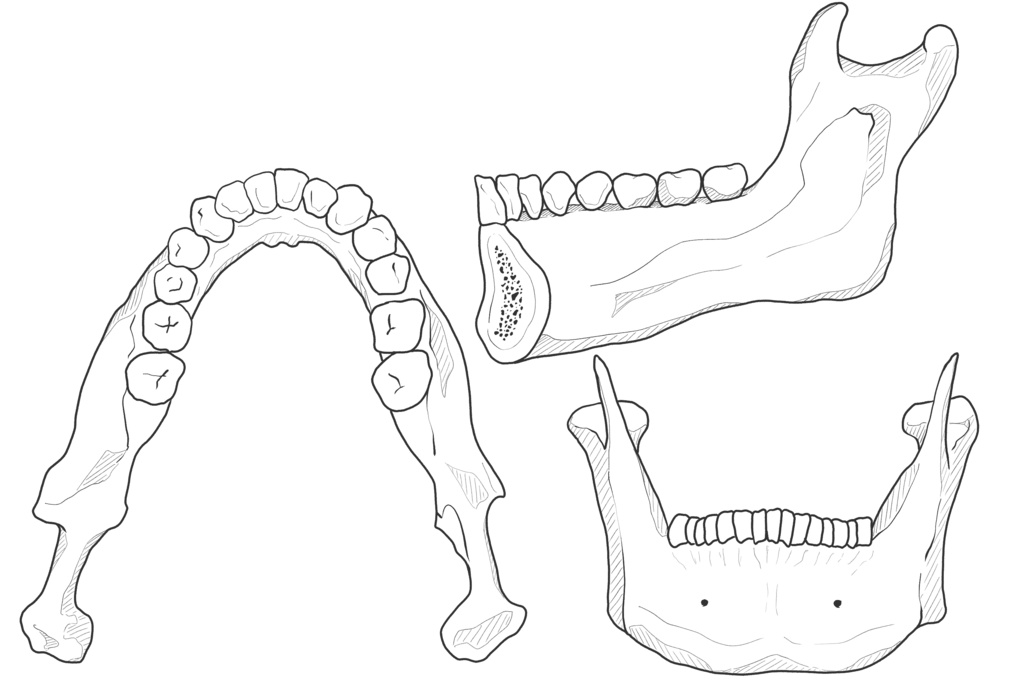 下顎骨　透過なし