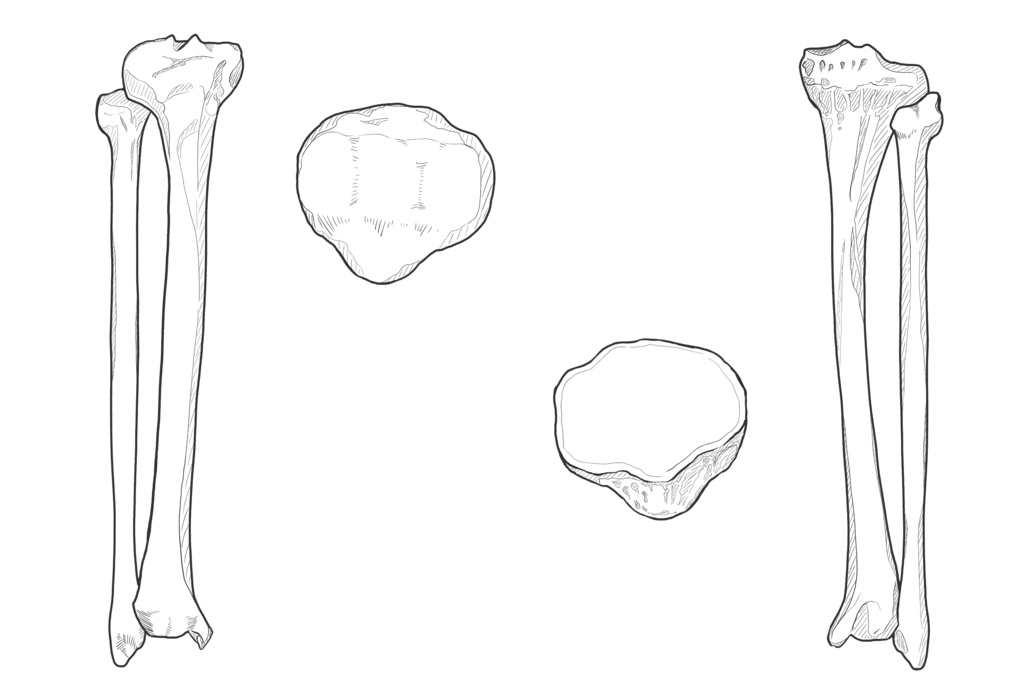 脛骨・腓骨・膝蓋骨 透過なし