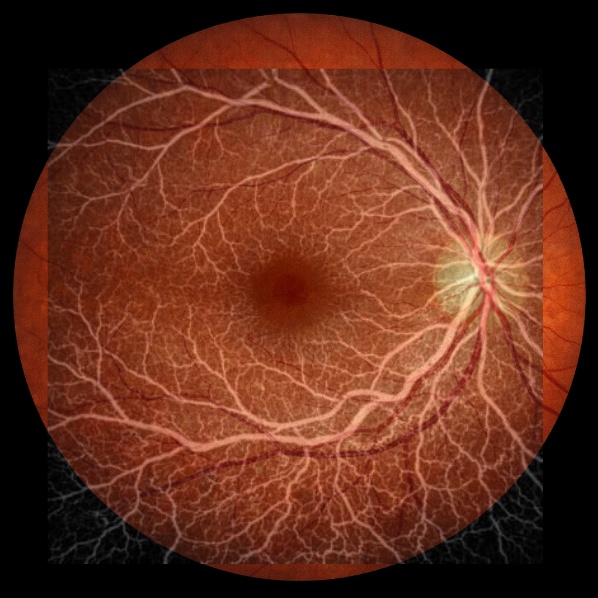 眼科画像オーバーレイ比較ツール|眼底・OCT画像を直感的に重ねて保存(ローカルHTML)