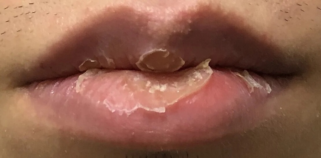 How I cured my exfoliative cheilitis in 2 years