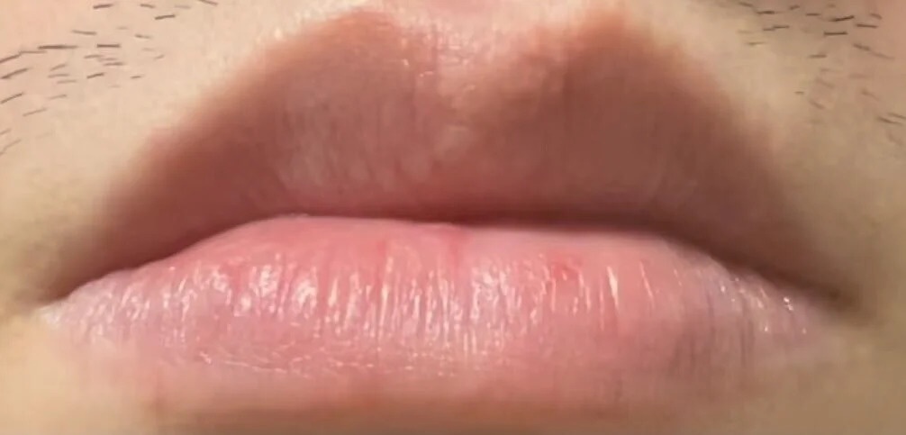 How I cured my exfoliative cheilitis in 2 years