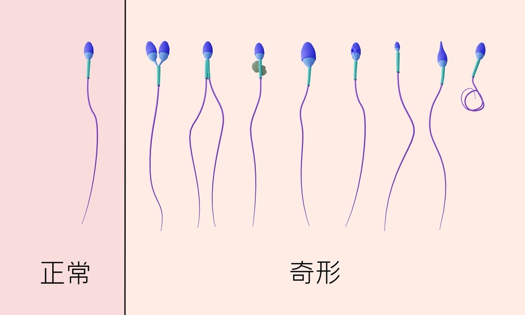 ヒト精子の病理学的形態のイラスト。正常精子と奇形精子。（日本語）