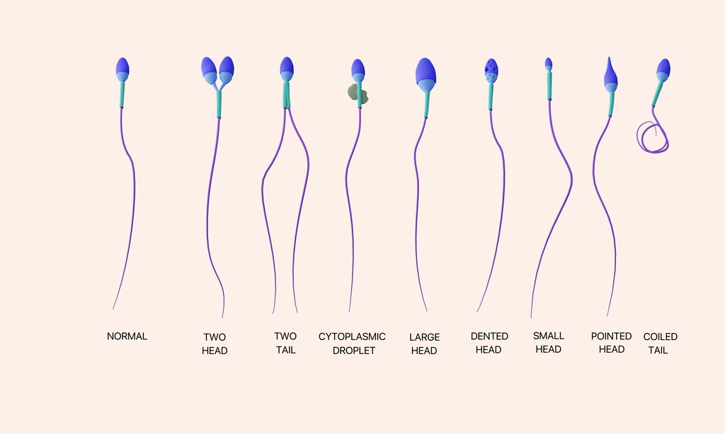 ヒト精子の病理学的形態のイラスト。正常精子と奇形精子。（英語）