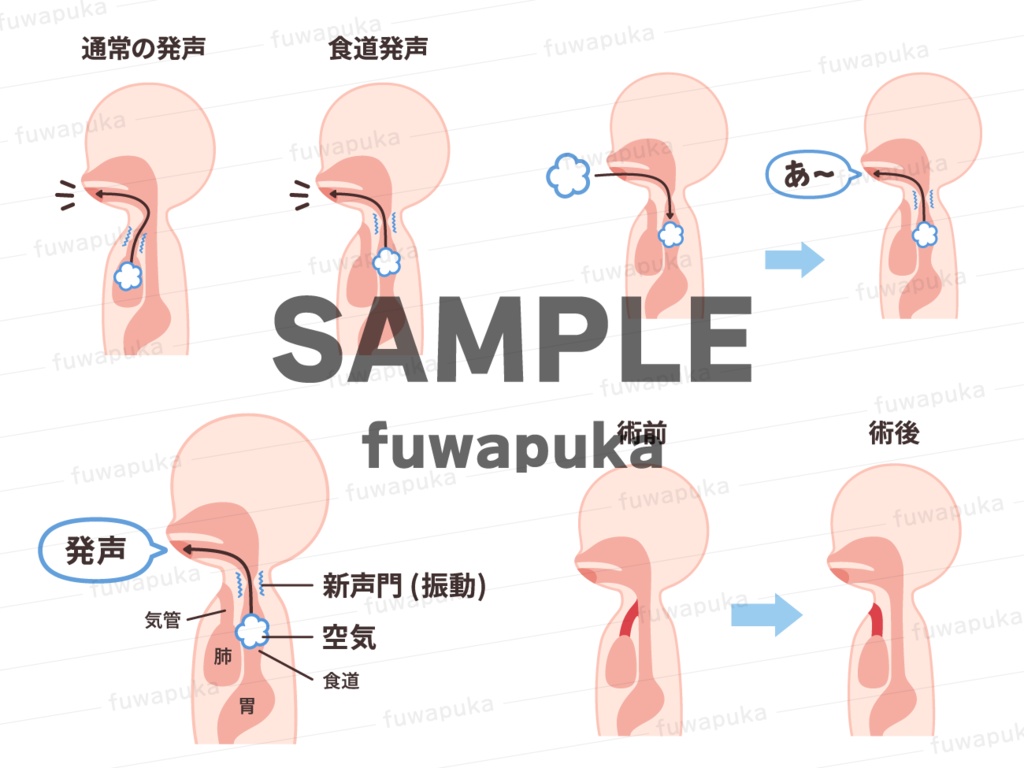 食道発声のイラスト素材_ベクター