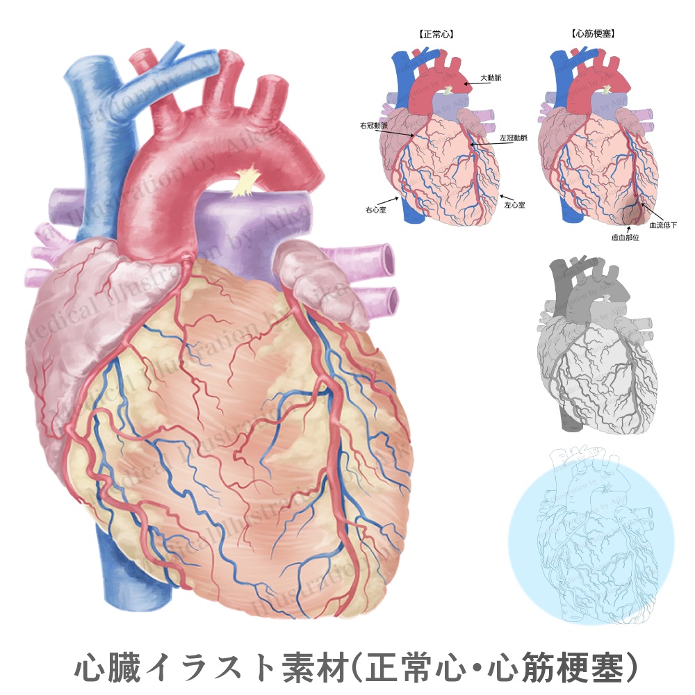 【医療・看護向け】心臓イラスト素材｜正常心・心筋梗塞 比較（A4／PNG／5点）
