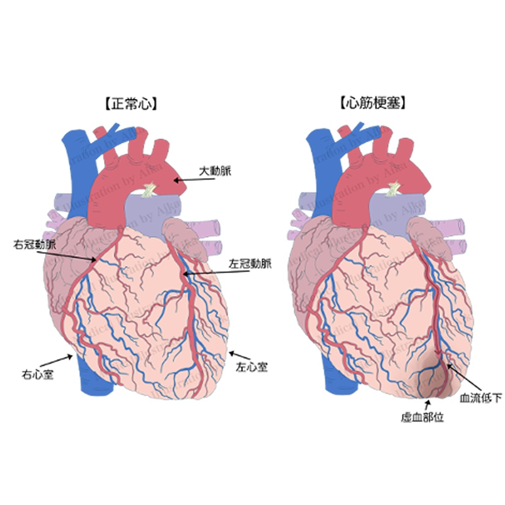 【医療・看護向け】心臓イラスト素材|正常心・心筋梗塞 比較(A4/PNG/5点)