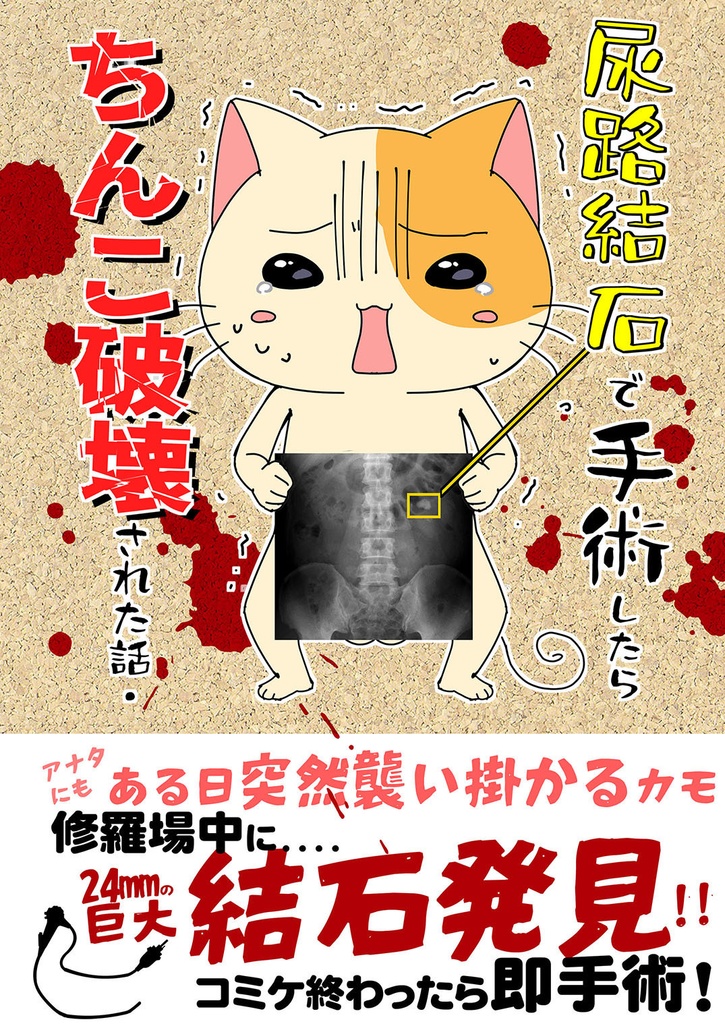 尿路結石で手術したらちんこ破壊された話