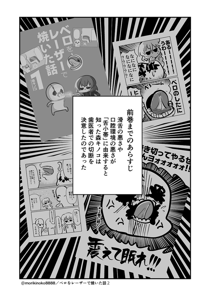 【電子書籍/紙の本】ベロをレーザーで焼いた話2