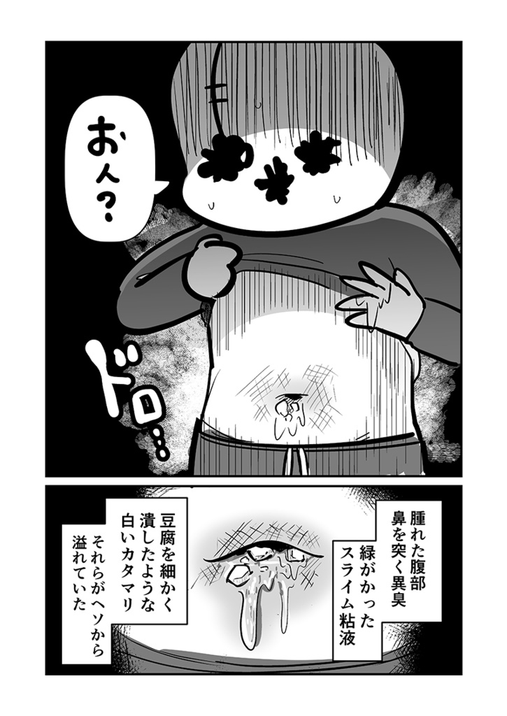 〆切に追われて栄養剤+仮眠を繰り返していたらおヘソから膿が出て入院した話2