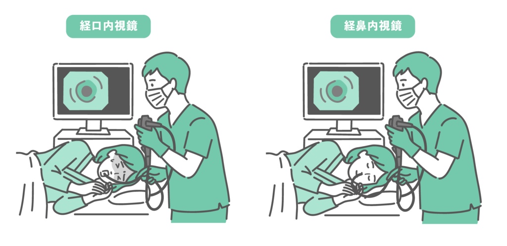 若い女性の経口内視鏡と経鼻内視鏡の比較イラスト(苦痛と安楽の違い)