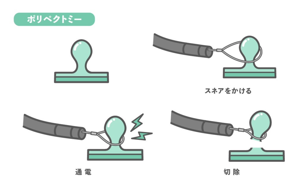 大腸ポリープ切除（ポリペクトミー）の手順・図解イラスト