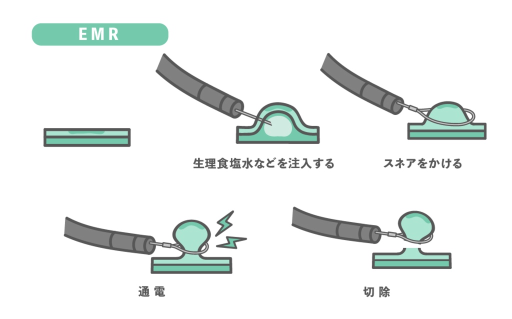 内視鏡的粘膜切除術(EMR)の手順・図解イラスト