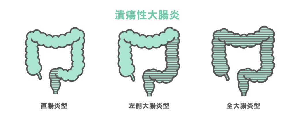 潰瘍性大腸炎の病変範囲分類（直腸炎型・左側大腸炎型・全大腸炎型）