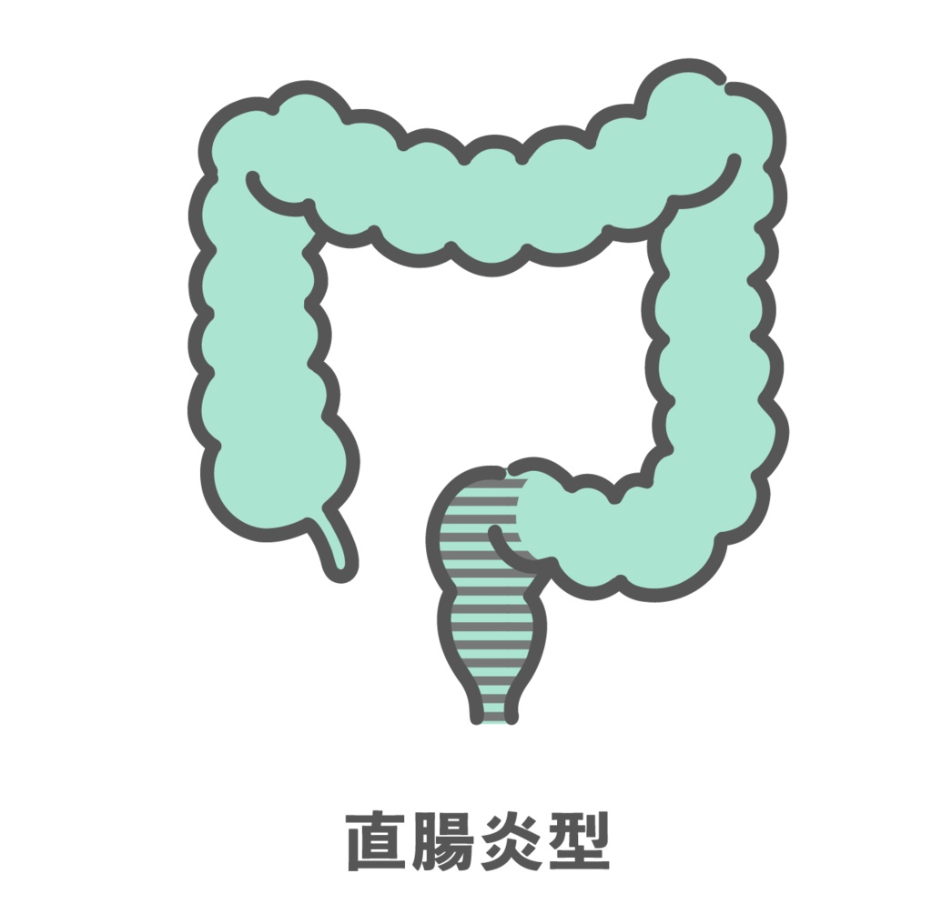 潰瘍性大腸炎・直腸炎型のイラスト（病変範囲）