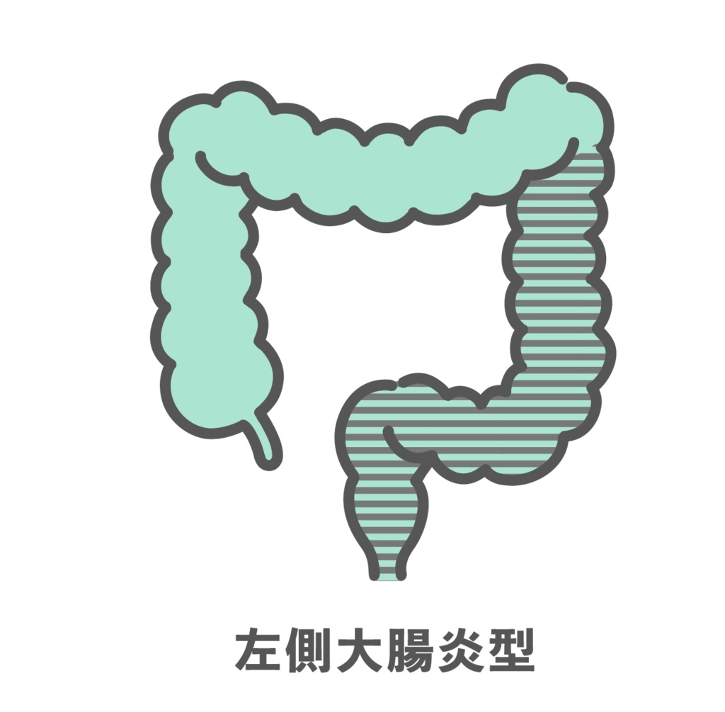 潰瘍性大腸炎・左側大腸炎型のイラスト（病変範囲）