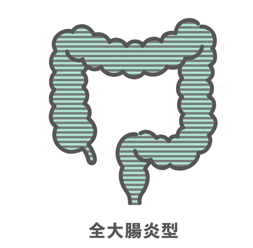 潰瘍性大腸炎・全大腸炎型のイラスト（病変範囲）